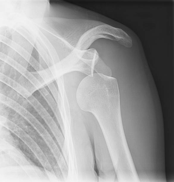 Addressing Shoulder Instability: Expert Insights from the Scortho Group