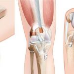 arthroscopic knee surgery fresno ca