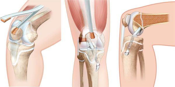 arthroscopic knee surgery fresno ca
