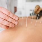 Your Top Picks For Acupuncture Needle Materials